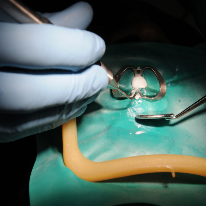 root canal