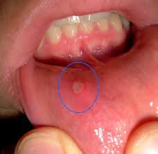 Canker Sore