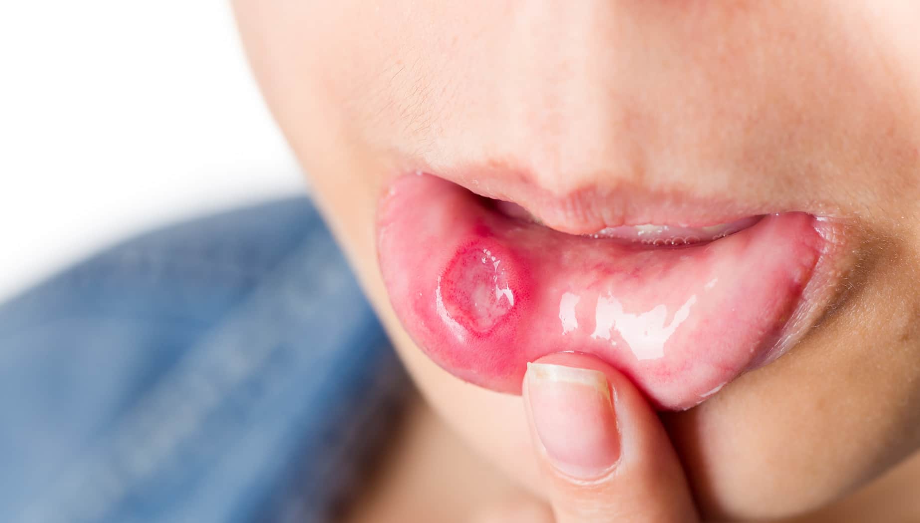 the-truth-behind-canker-sores-causes-of-canker-sores